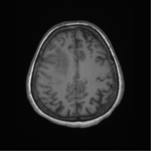 Cerebral metastasis to basal ganglia (Radiopaedia 81568-95413 Axial T1 55).png