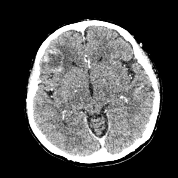 Cerebral ring enhancing lesions - cerebral metastases (Radiopaedia 44922-48818 B 132).jpg