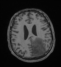 Cerebral toxoplasmosis (Radiopaedia 43956-47461 Axial T1 52).jpg