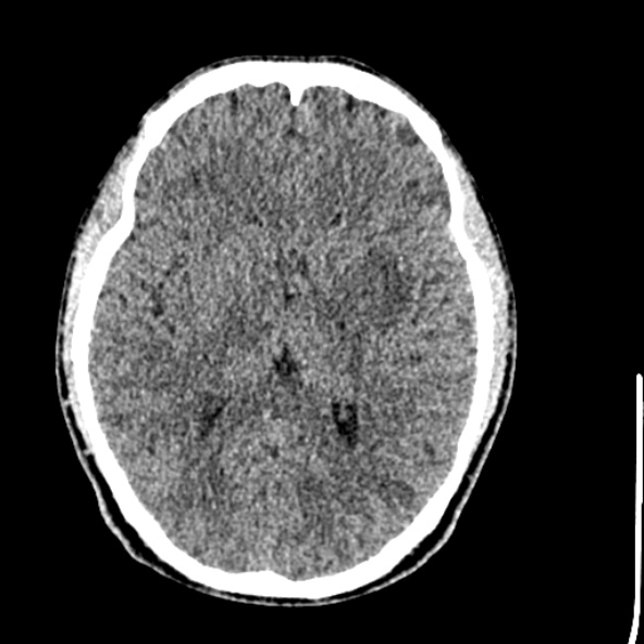 File:Cerebral toxoplasmosis (Radiopaedia 53993-60131 Axial non-contrast 41).jpg