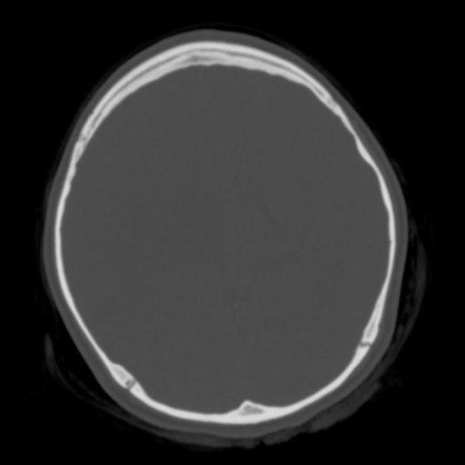 File:Cerebral tuberculosis with dural sinus invasion (Radiopaedia 60353-68018 Axial bone window 35).jpg