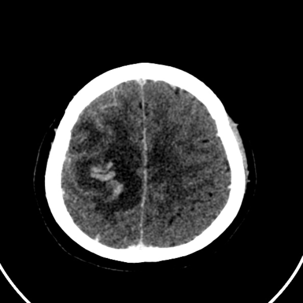 Cerebral venous hemorrhagic infarct from venous sinus thrombosis (Radiopaedia 55433-61883 Axial C+ delayed 36).jpg