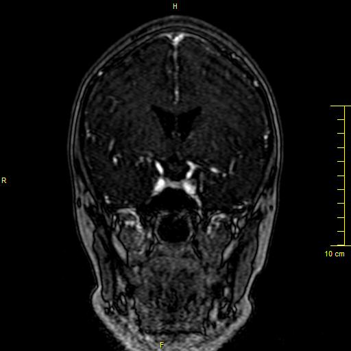 Cerebral venous thrombosis (Radiopaedia 23288-23351 MRV 52).JPG