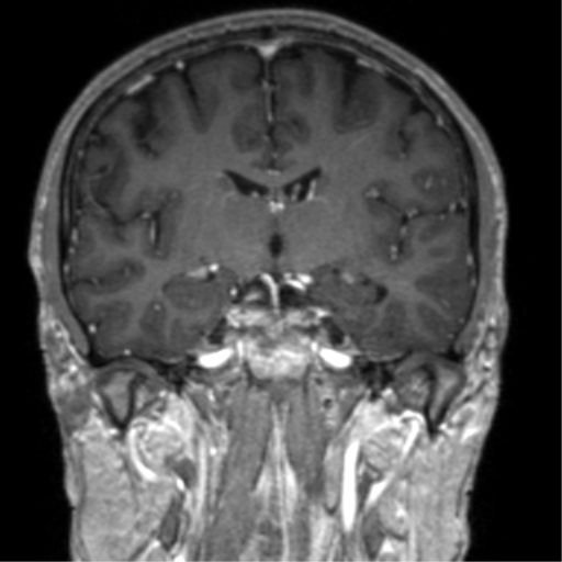 Cerebral venous thrombosis (Radiopaedia 38392-40469 Coronal T1 C+ 46).png