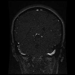 Cerebral venous thrombosis - ulcerative colitis (Radiopaedia 66049-75219 Coronal MRV 45).jpg