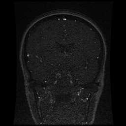 Cerebral venous thrombosis - ulcerative colitis (Radiopaedia 66049-75219 Coronal MRV 68).jpg