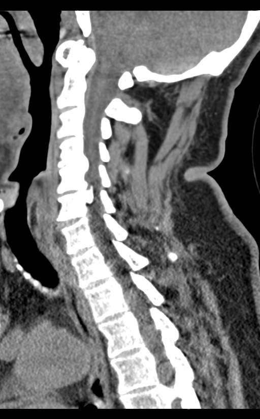Cervical canal stenosis - OPLL and osteophytes (Radiopaedia 47329-51910 B 36).png