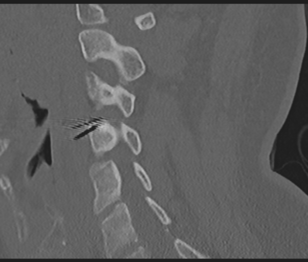Cervical disc replacement (Radiopaedia 44025-47541 Sagittal bone window 35).png