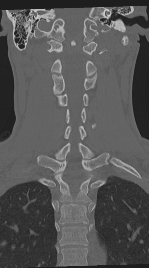 Cervical intercalary bone (Radiopaedia 35211-36748 Coronal bone window 45).png