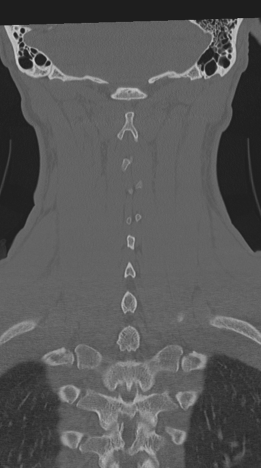 Cervical intercalary bone (Radiopaedia 35211-36748 Coronal bone window 59).png
