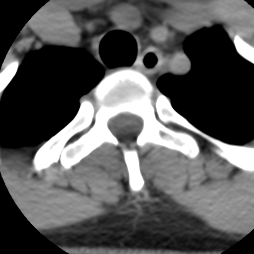 Cervical schwannoma (Radiopaedia 57979-64974 Axial non-contrast 65).png