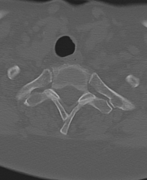 Cervical spine ACDF loosening (Radiopaedia 48998-54071 Axial bone window 53).png