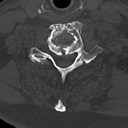 Cervical spine fracture - chalk stick (Radiopaedia 39116-41323 Axial bone window 68).png