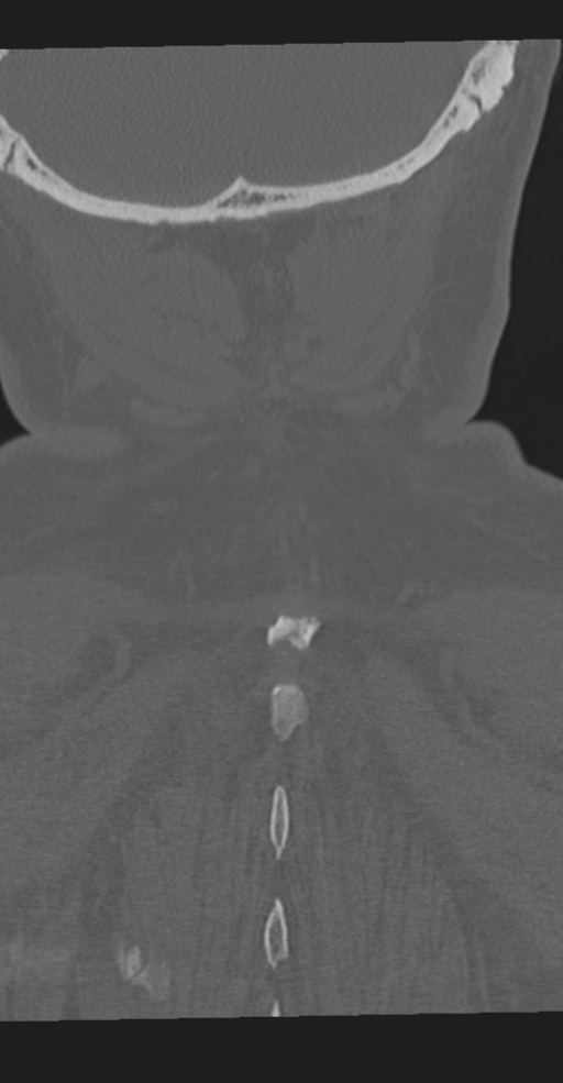 Cervical spine fracture in the setting of ankylosis (Radiopaedia 37038-38715 Coronal bone window 67).png