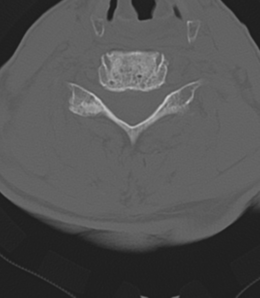 Cervical spine fractures with vertebral artery dissection (Radiopaedia 53296-59268 Axial bone window 35).png