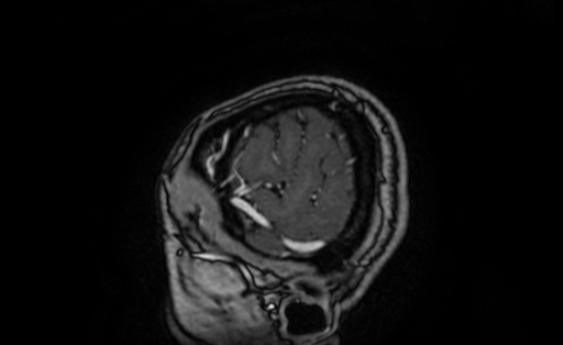 Cervical spondylodiscitis and calvarial hemangioma (Radiopaedia 64317-73103 Sagittal T1 C+ 5).jpg