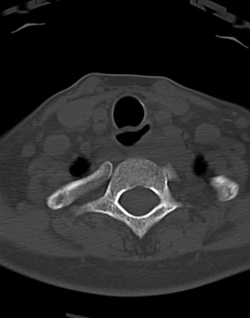 Cervical tuberculous spondylitis (Radiopaedia 39149-41365 Axial bone window 45).png