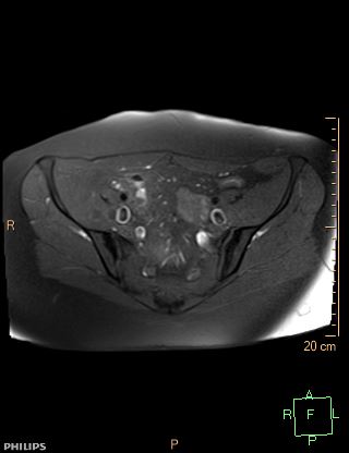 File:Cesarian scar endometriosis (Radiopaedia 68495-78066 Axial T1 fat sat 6).jpg
