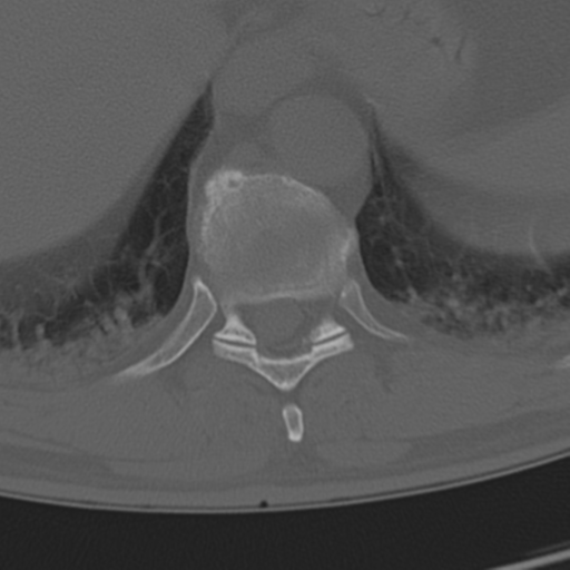 Chance fracture (Radiopaedia 33854-35020 Axial bone window 66).png