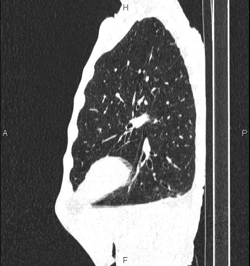Chilaiditi sign (Radiopaedia 88839-105611 Sagittal lung window 72).jpg