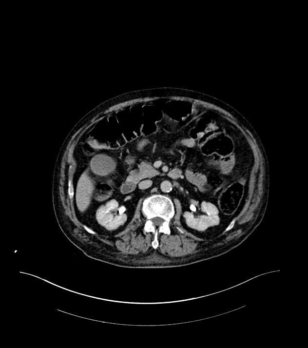 Cholangiocarcinoma with cerebral metastases (Radiopaedia 83519-98629 Axial C+ delayed 46).jpg