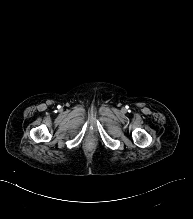 Cholangiocarcinoma with cerebral metastases (Radiopaedia 83519-98629 B 134).jpg