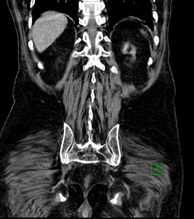 Cholangiocarcinoma with cerebral metastases (Radiopaedia 83519-98629 G 67).jpg