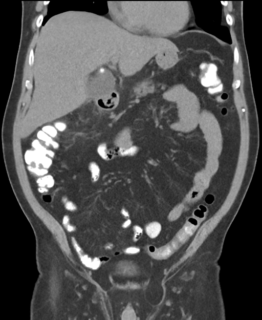 Cholecystitis with focal perforation and hepatic abscess (Radiopaedia 37189-38945 Coronal non-contrast 22).png
