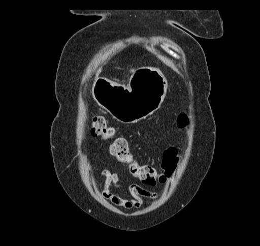 Cholecystoduodenal fistula (Radiopaedia 48959-54022 B 30).jpg