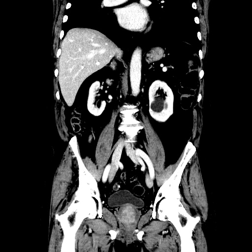 Choledocholiathiasis with normal caliber common bile duct (Radiopaedia 75368-86632 Coronal liver window 74).jpg