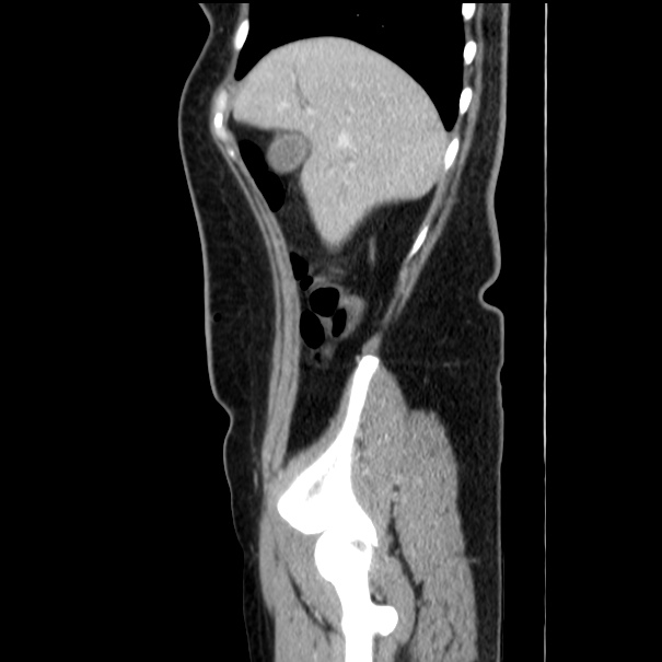 Choledocholithiasis on CT and MRI (Radiopaedia 24825-25087 D 14).jpg