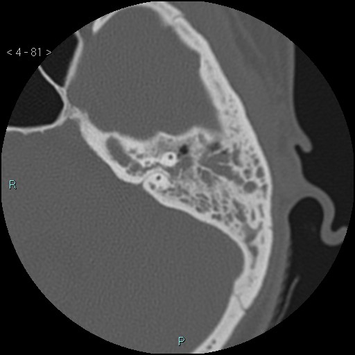 File:Cholesterol granuloma of the petrous apex (Radiopaedia 64358-73141 Axial bone window 39).jpg