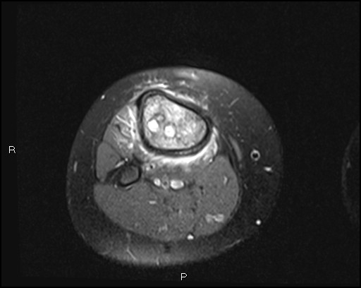 File:Chondroblastoma (Radiopaedia 62721-71031 Axial PD fat sat 29).jpg
