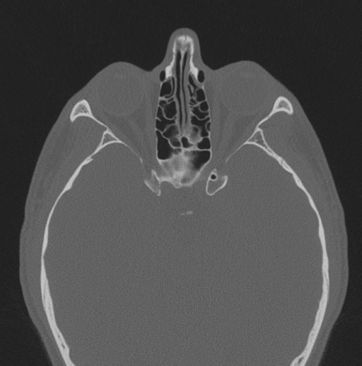 Chondrosarcoma (clivus) (Radiopaedia 46895-51425 Axial bone window 28).png