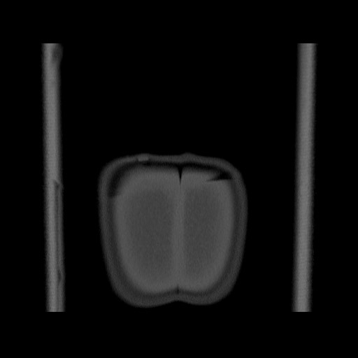 Chondrosarcoma of iliac wing (Radiopaedia 63861-72599 Coronal bone window 118).jpg