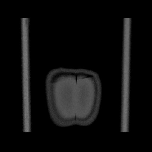 Chondrosarcoma of iliac wing (Radiopaedia 63861-72599 Coronal bone window 119).jpg