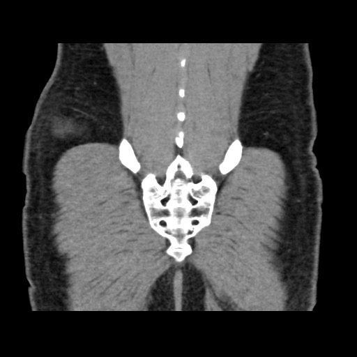 Chondrosarcoma of iliac wing (Radiopaedia 63861-72599 Coronal non-contrast 100).jpg