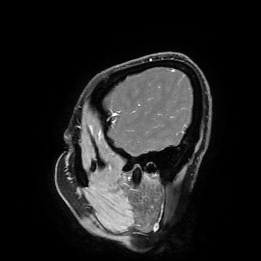 Chordoid glioma of third ventricle (Radiopaedia 91612-109340 F 37).jpg