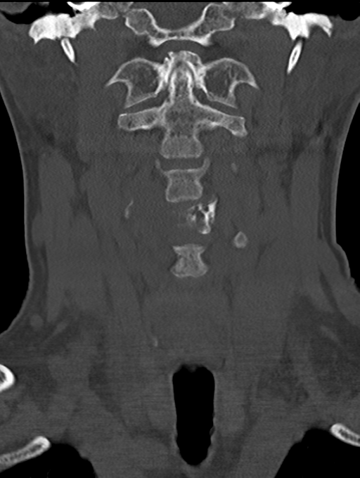Chordoma (C4 vertebra) (Radiopaedia 47561-52188 Coronal bone window 13).png