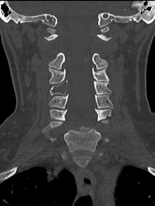 Chordoma (C4 vertebra) (Radiopaedia 47561-52188 Coronal bone window 26).png