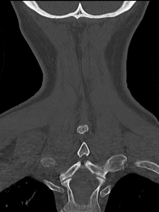 Chordoma (C4 vertebra) (Radiopaedia 47561-52188 Coronal bone window 53).png
