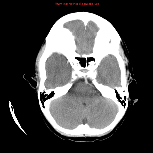 File:Choroid plexus carcinoma - recurrent (Radiopaedia 8330-9168 B 6).jpg