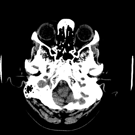 Choroid plexus xanthogranulomas (Radiopaedia 51621-57408 Axial non-contrast 12).jpg