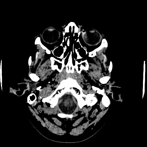 Choroid plexus xanthogranulomas (Radiopaedia 51621-57408 Axial non-contrast 7).jpg