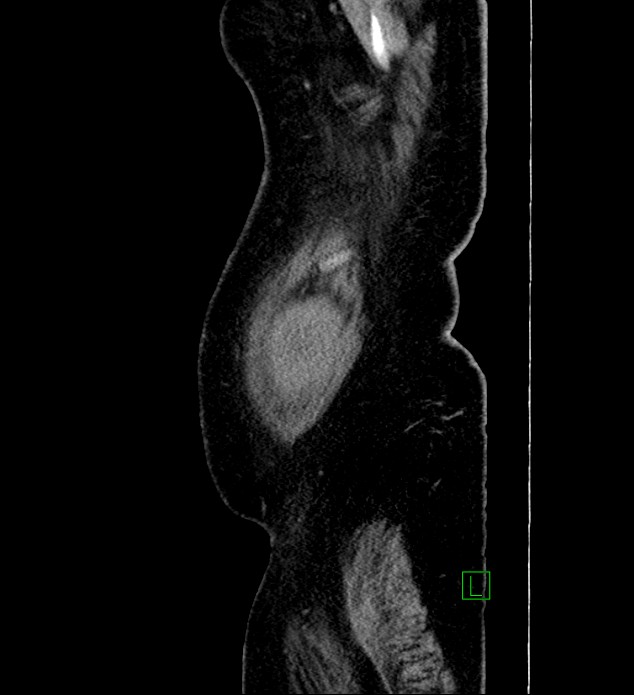 Chromophobe renal cell carcinoma (Radiopaedia 84239-99519 G 112).jpg