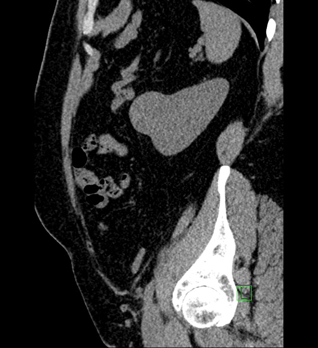 Chromophobe renal cell carcinoma (Radiopaedia 84286-99573 C 39).jpg