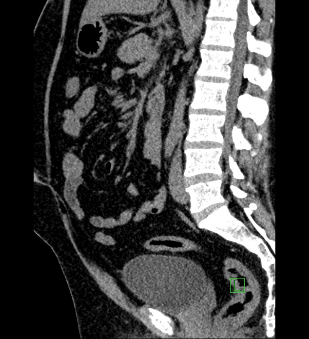 Chromophobe renal cell carcinoma (Radiopaedia 84286-99573 C 88).jpg