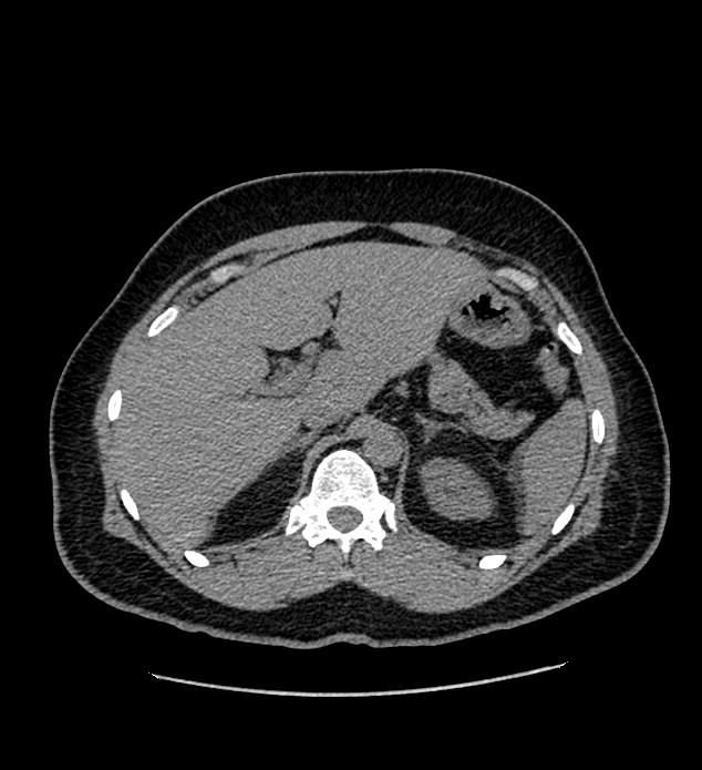 Chromophobe renal cell carcinoma (Radiopaedia 84337-99693 Axial non-contrast 32).jpg