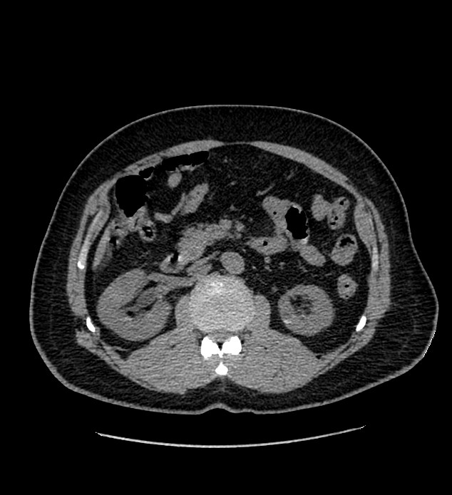 Chromophobe renal cell carcinoma (Radiopaedia 84337-99693 Axial non-contrast 55).jpg