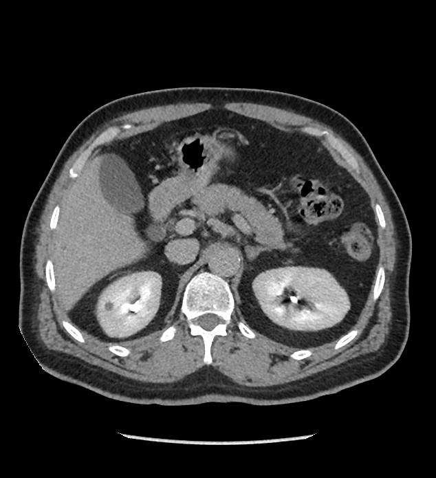 Chromophobe renal cell carcinoma (Radiopaedia 86879-103083 D 42).jpg